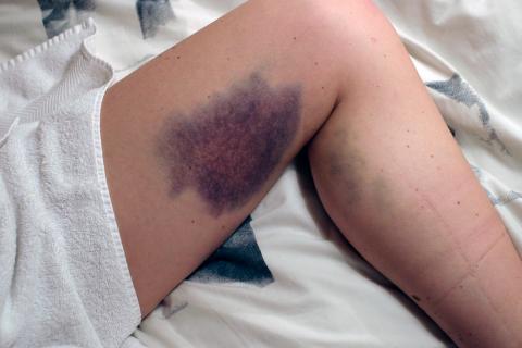 Bruise. The Dutch for "bruise" is "kneuzing".