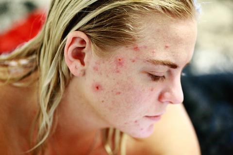 Many pimples on her face. The Thai for "many pimples on her face" is "สิวจำนวนมากบนใบหน้าเธอ".