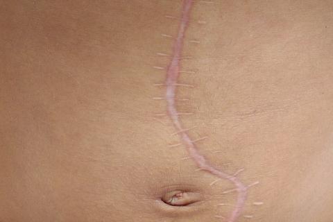 Scar. The Thai for "scar" is "แผลเป็น". Scar. The Thai for "scar" is "แผลเป็น".