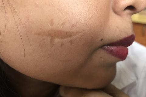 Scars on her cheek. The Thai for "scars on her cheek" is "แผลเป็นบนแก้มของเธอ".