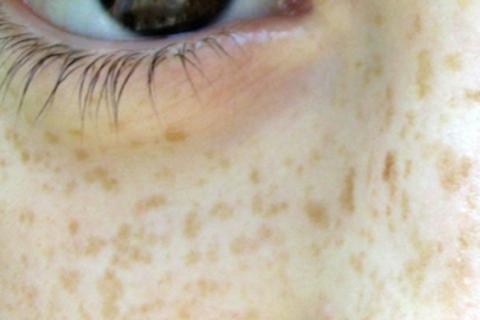 Freckles. The Thai for "freckles" is "กระ". Freckles. The Thai for "freckles" is "กระ".